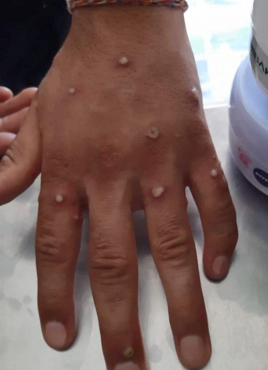 Sultangazi'de maymun çiçeği şüphesi