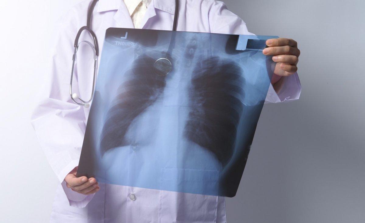 Akciğer kanserinde sigara dışında 7 risk faktörü