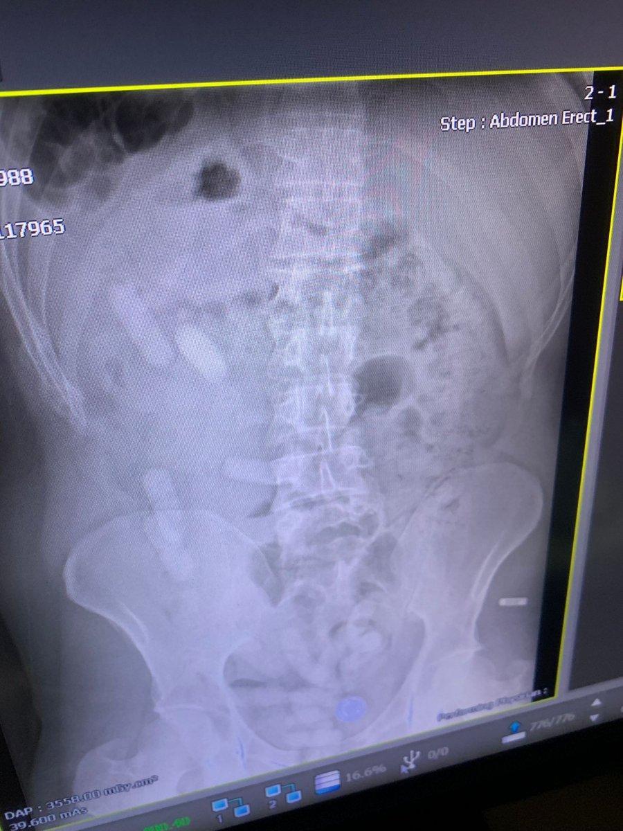 Sivas'taki İranlı yolcunun midesinden uyuşturucu çıktı