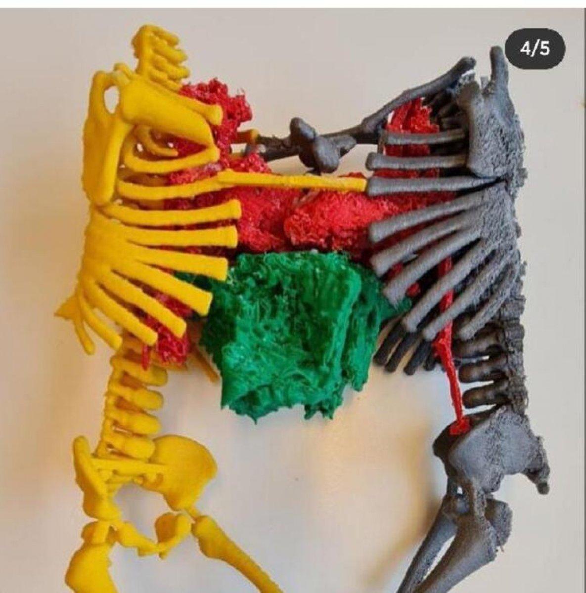 Cezayirli siyam ikizleri İstabul'da ayrıldı