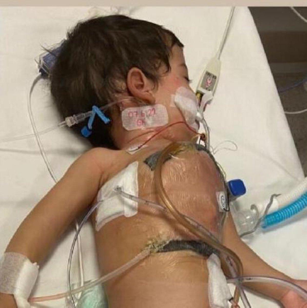 Cezayirli siyam ikizleri İstabul'da ayrıldı