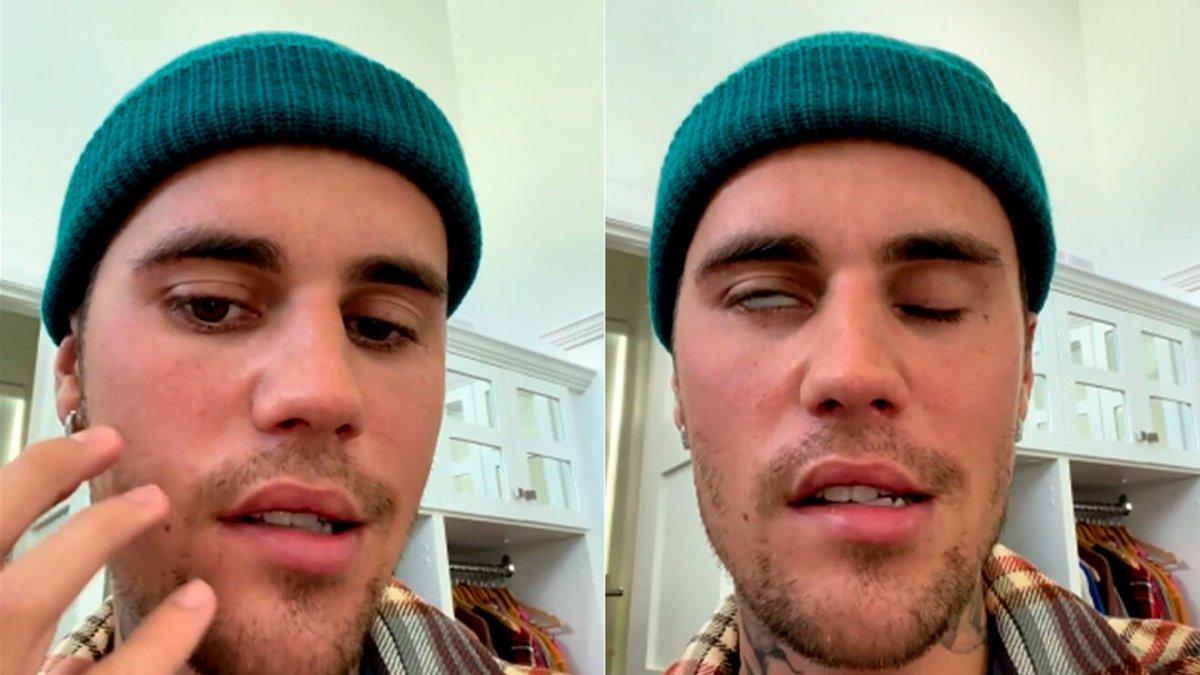 Justin Bieber, yüz felcine yakalandı