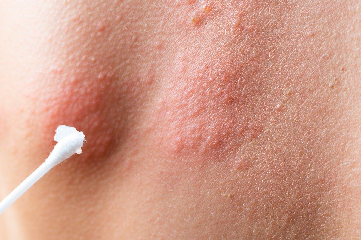 Bulaşıcı olan zona hastalığı hakkında bilinmesi gerekenler