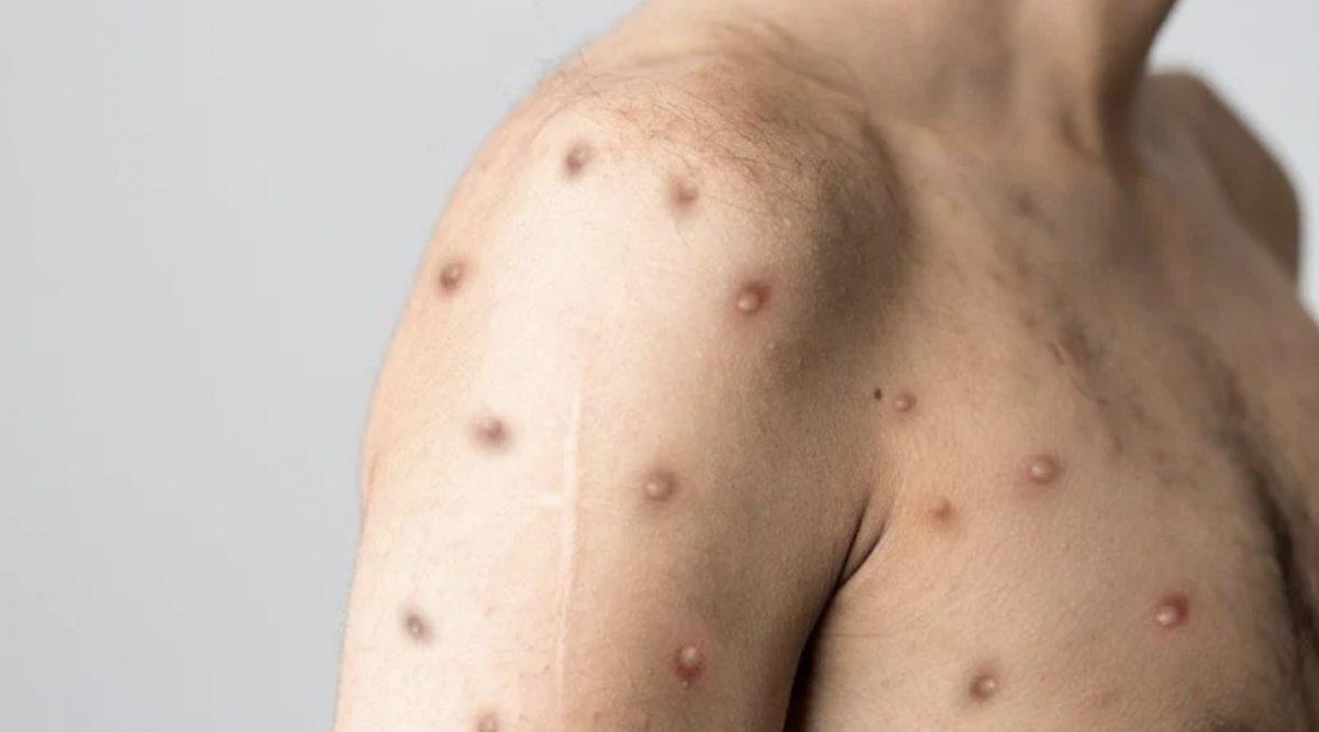 Maymun çiçeği virüsünün ismi ırkçılık riskinden dolayı değiştiriliyor