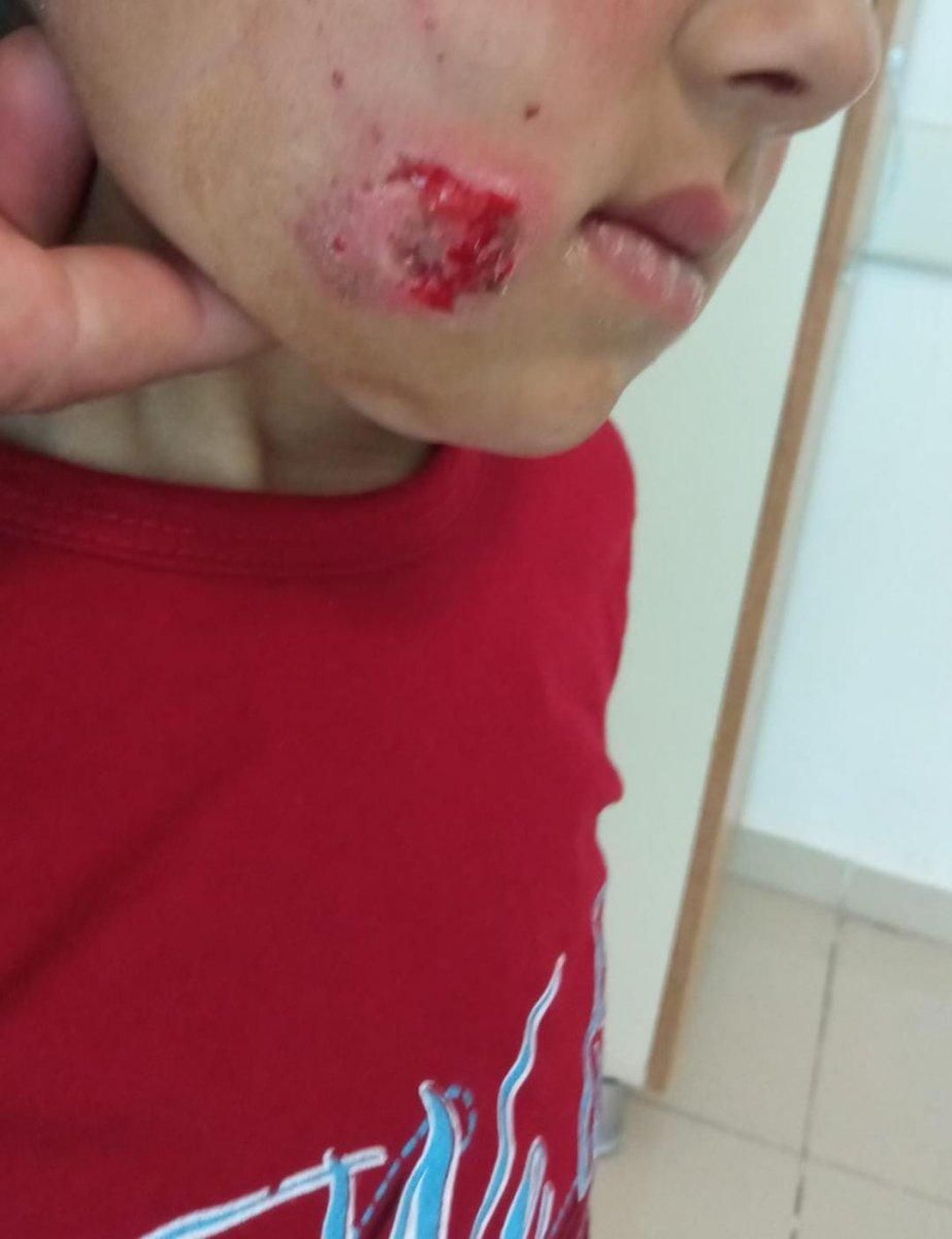 Ağrı'da sokak köpeklerinin saldırdığı minik Asaf yaşamını yitirdi