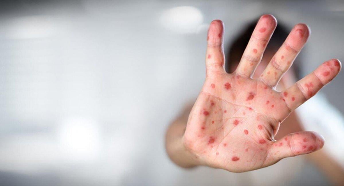 Türkiye'de maymun çiçeği vakası görüldü: Belirtileri neler, kimler risk altında