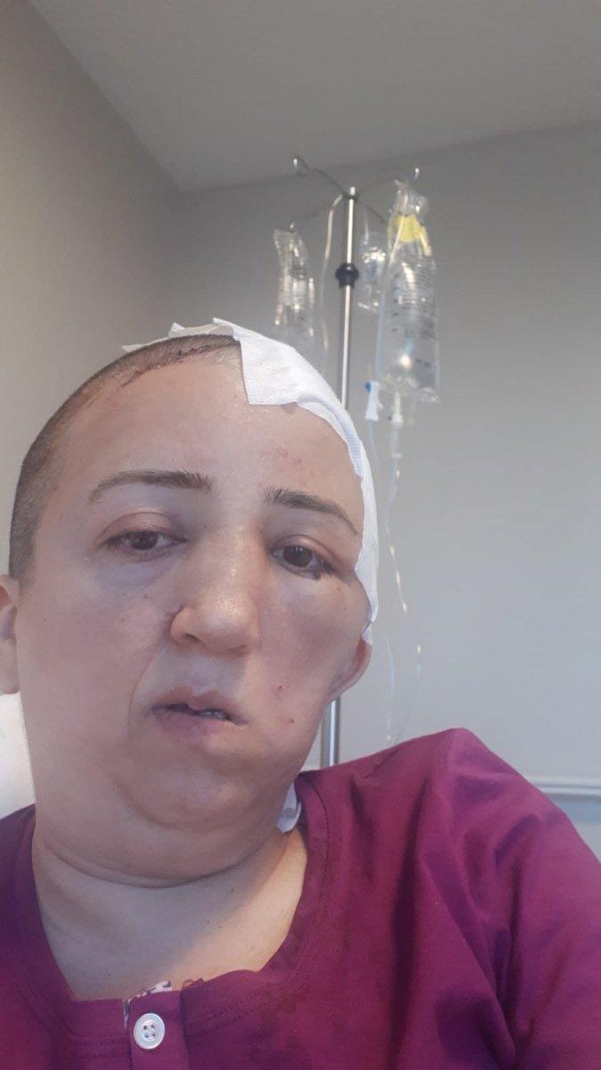 Giresunlu hemşirenin kafatası, ameliyat sırasında kayboldu