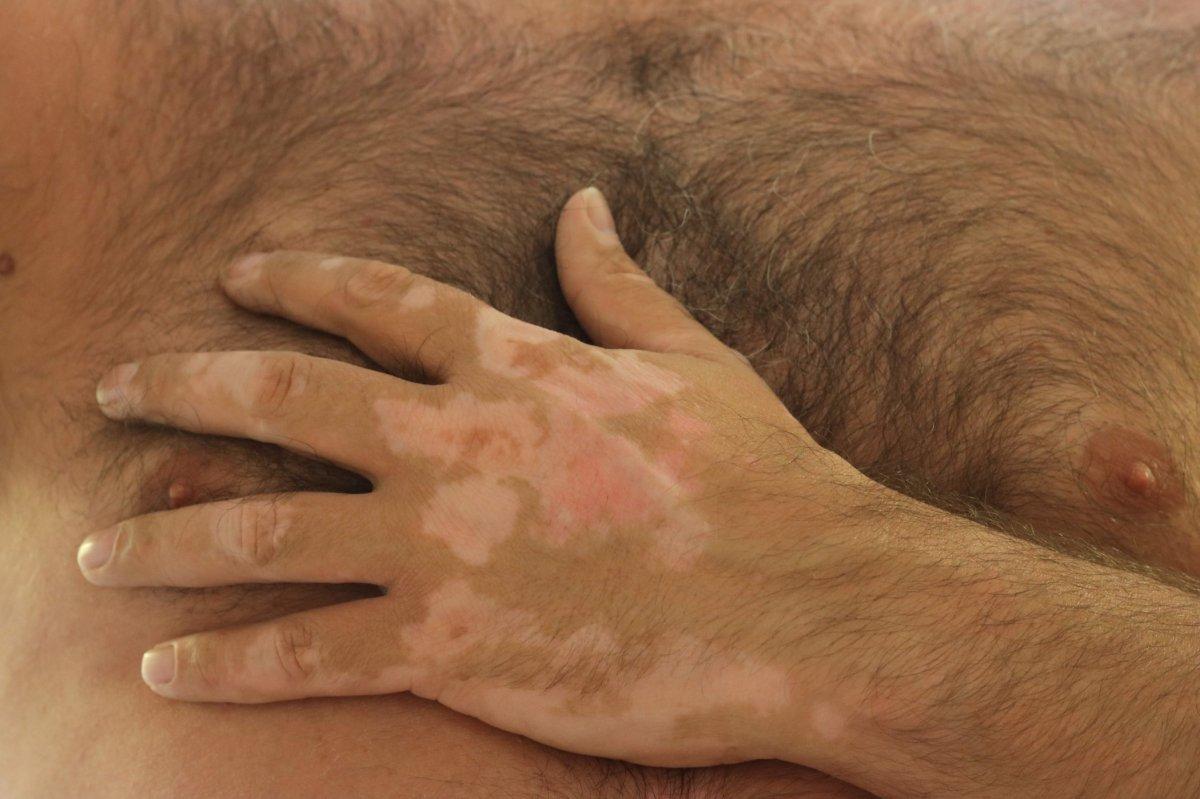 Sade güneşlenmek yetiyor! Bu 4 hastalık güneşle tedavi edilebiliyor