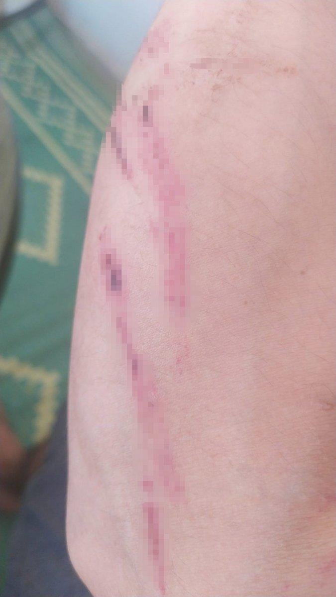 Nevşehir'de komşular arasındaki kavgada kulak memesi kopartıldı