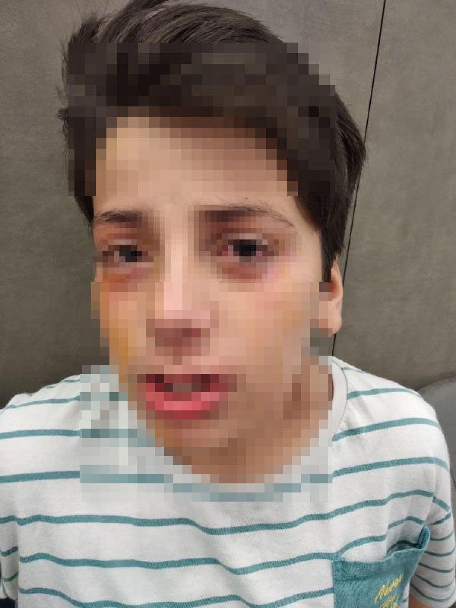 Adana'da video izleyip ses bombası yapan çocuk, gözünden yaralandı