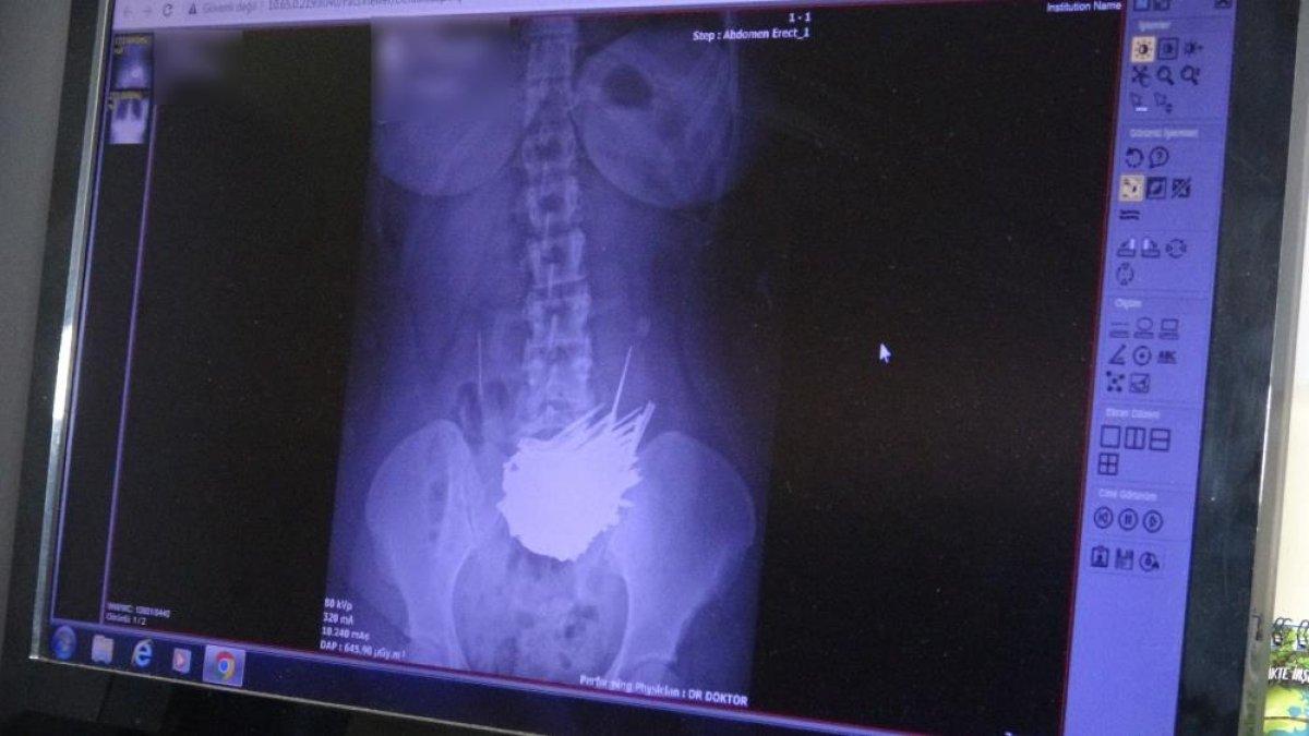 Van'daki hastanın midesinden çok sayıda kesici alet çıktı