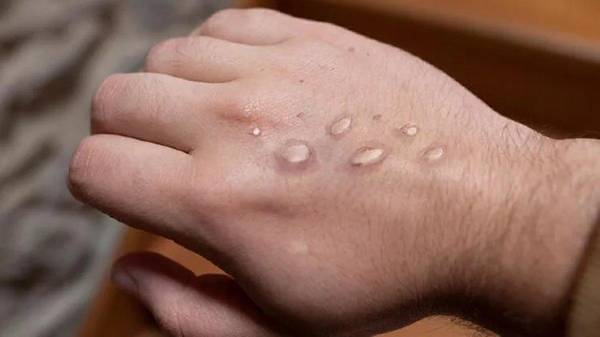 Maymun çiçeği belirtileri hangi sırayla ortaya çıkıyor?