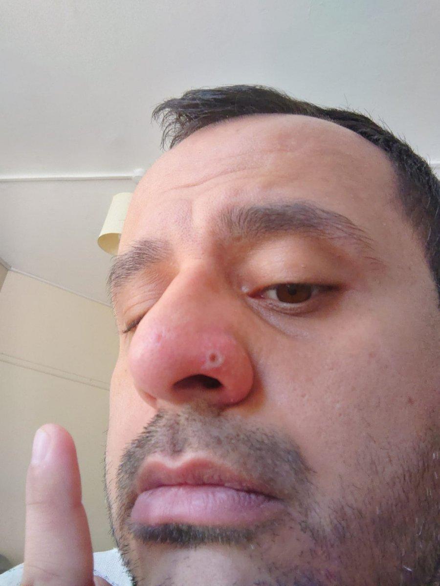 HIV, koronavirüs ve maymun çiçeğini geçirdi, damgalanmaktan kurtulamadı