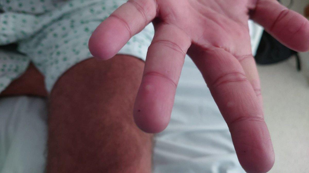 HIV, koronavirüs ve maymun çiçeğini geçirdi, damgalanmaktan kurtulamadı