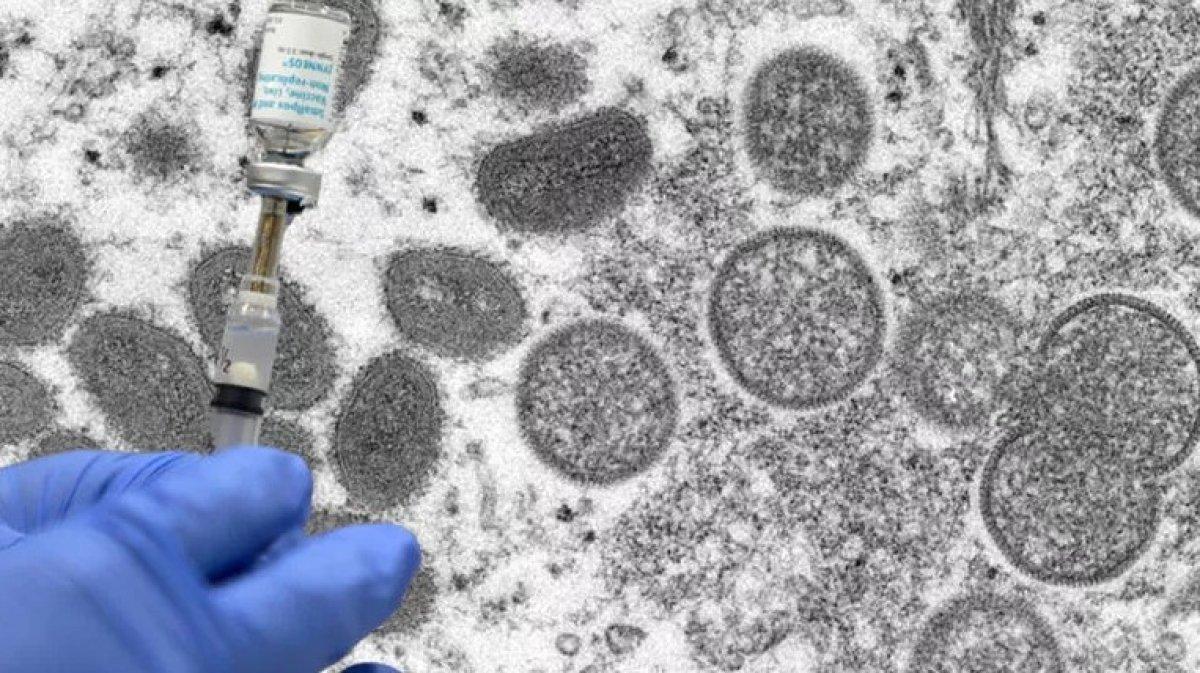 Türkiye'de 5 maymun çiçeği vakası tespit edildi