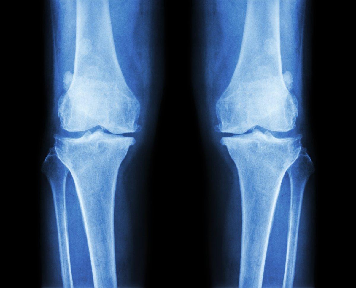 Eklem kireçlenmeleri tehlike yaratıyor