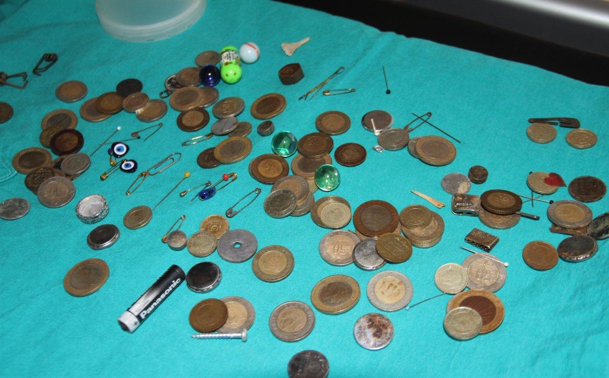 Elazığ’da çocukların midesinden çıkan yabancı cisimler şaşırttı