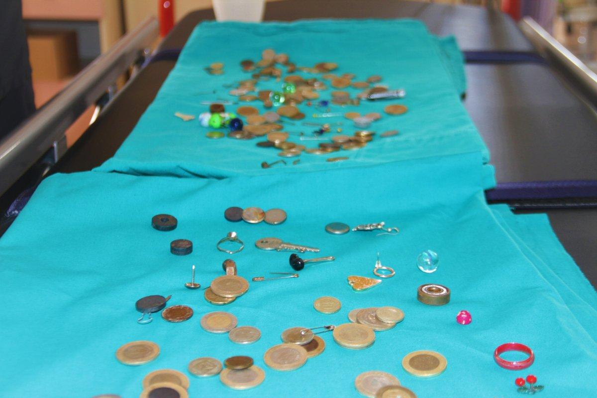 Elazığ’da çocukların midesinden çıkan yabancı cisimler şaşırttı