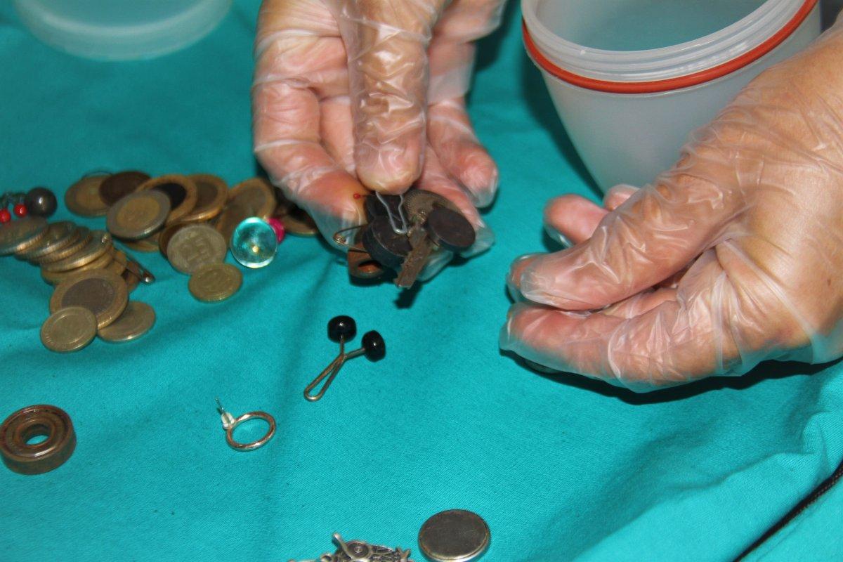 Elazığ’da çocukların midesinden çıkan yabancı cisimler şaşırttı