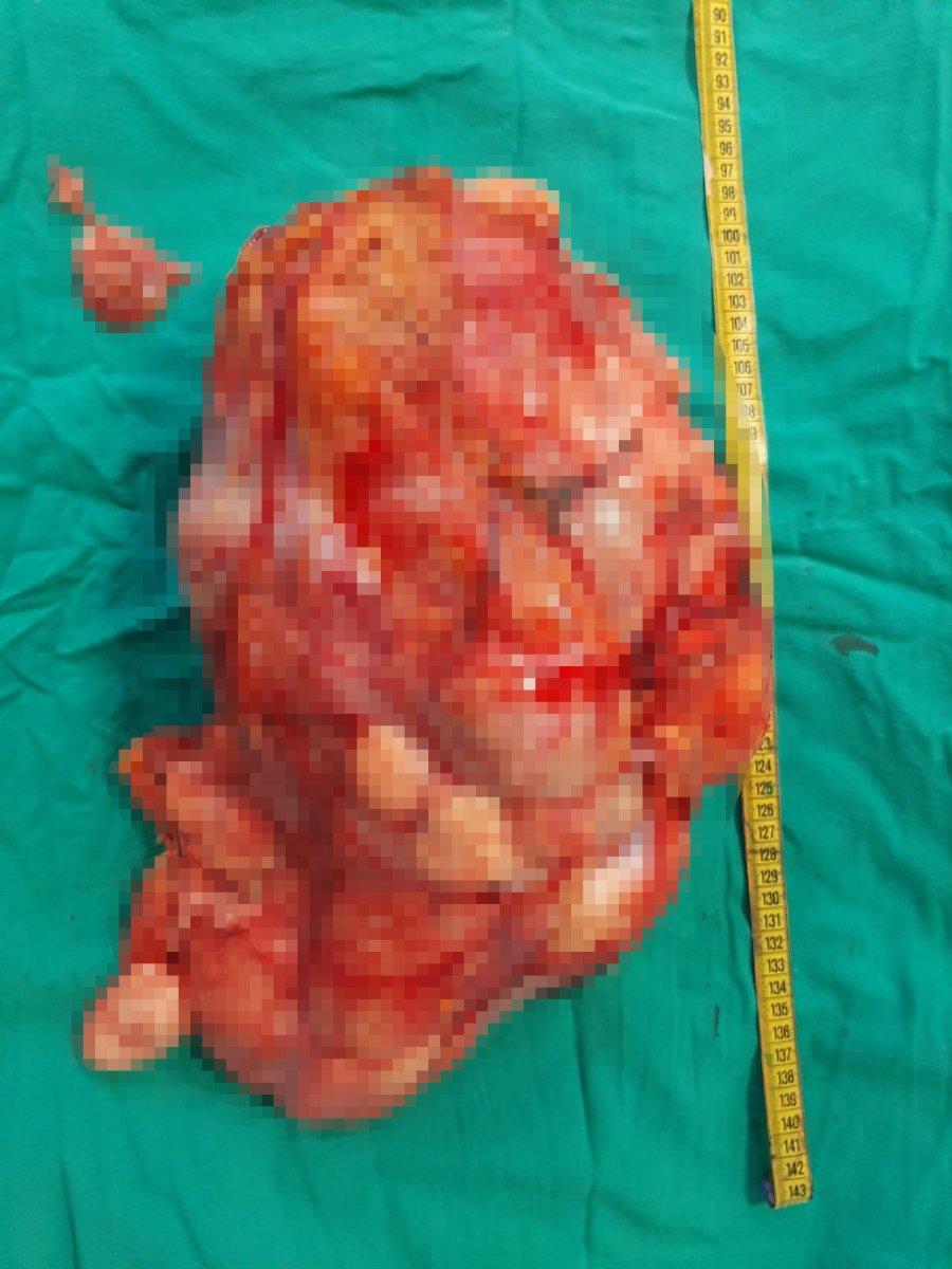 Adana’da, kadının karnından 10 kilogram kanserli kitle çıkarıldı