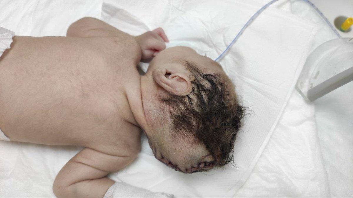 Kahramanmaraş’taki bebek beyninin yarısı kafatası dışında dünyaya geldi