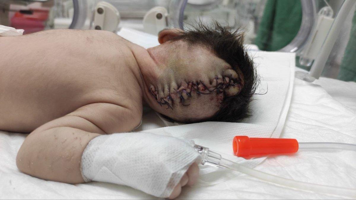 Kahramanmaraş’taki bebek beyninin yarısı kafatası dışında dünyaya geldi