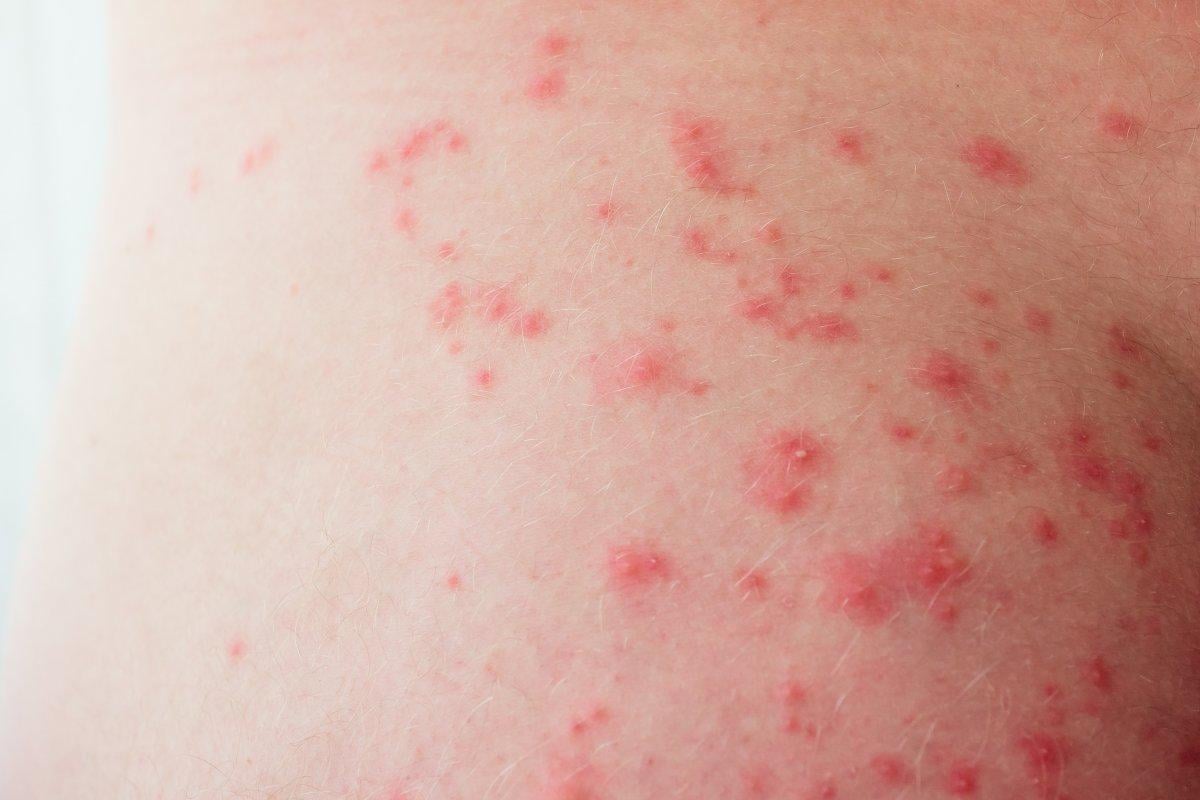 Bacaklardaki kırmızı noktaların en yaygın 10 nedeni