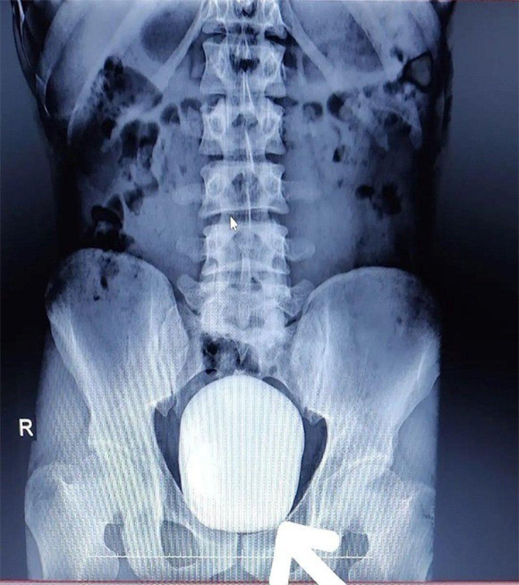 Karaman'da hastaneye başvuran hastanın mesanesinden 1 kilo taş çıktı
