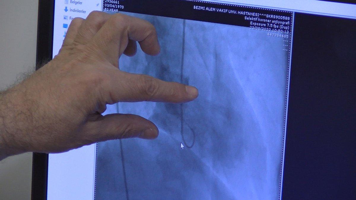 İstanbul'da kalp krizi geçirdi sanıldı, kırık kalp sendromu çıktı