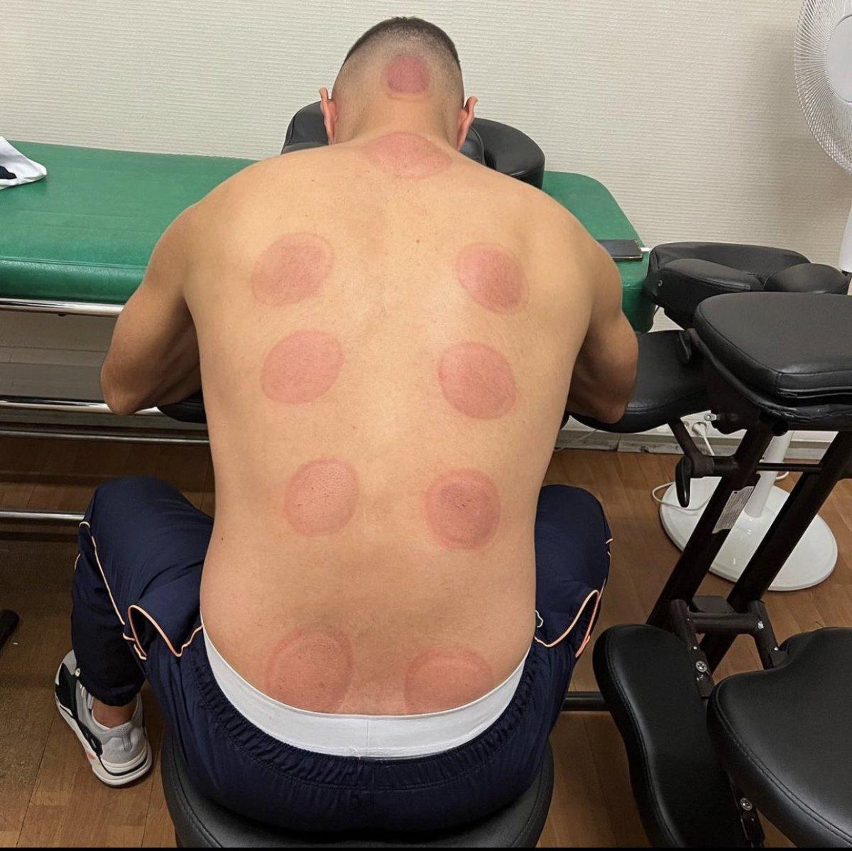 Karim Benzema hacamat yaptırdı