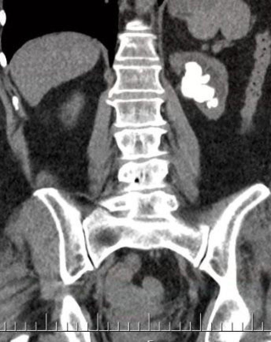 Çanakkale’de kadının böbreğindeki taş, 100 parçaya ayrılarak çıkarıldı
