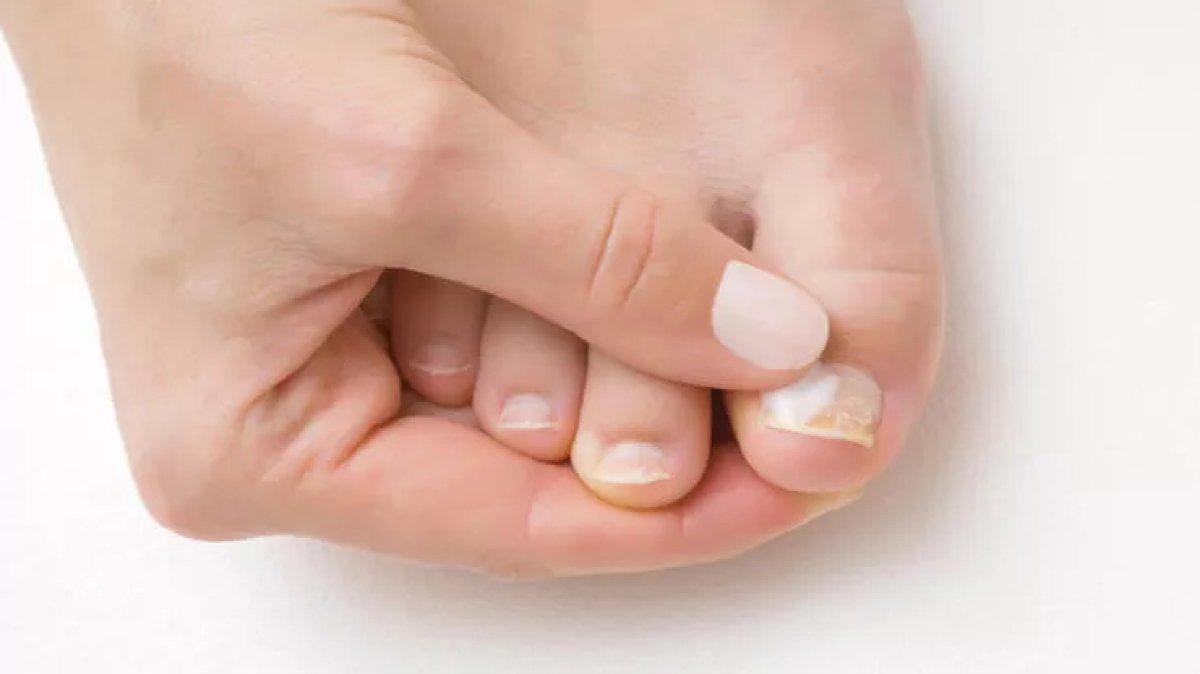 Tırnak mantarına ilaç gibi tavsiye: Bu doğal kürle mantara veda edin!