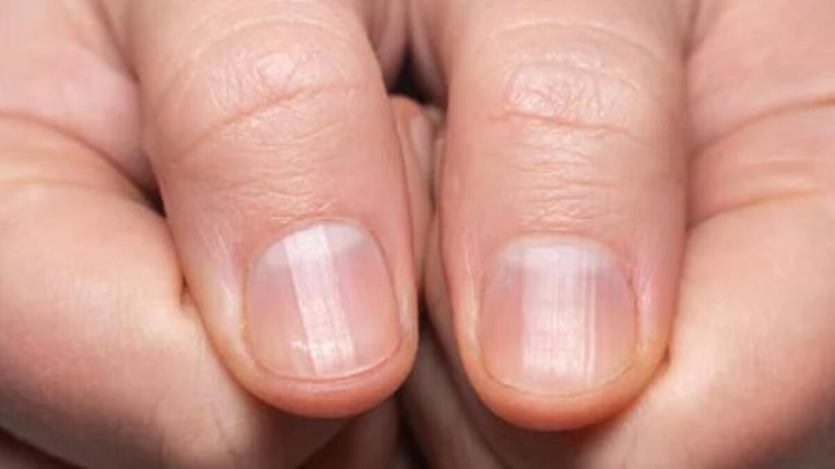Tırnaklardaki bu belirti ağır bir hastalık habercisi olabilir! Çoğu zaman dikkate alınmayan belirtiye dikkat