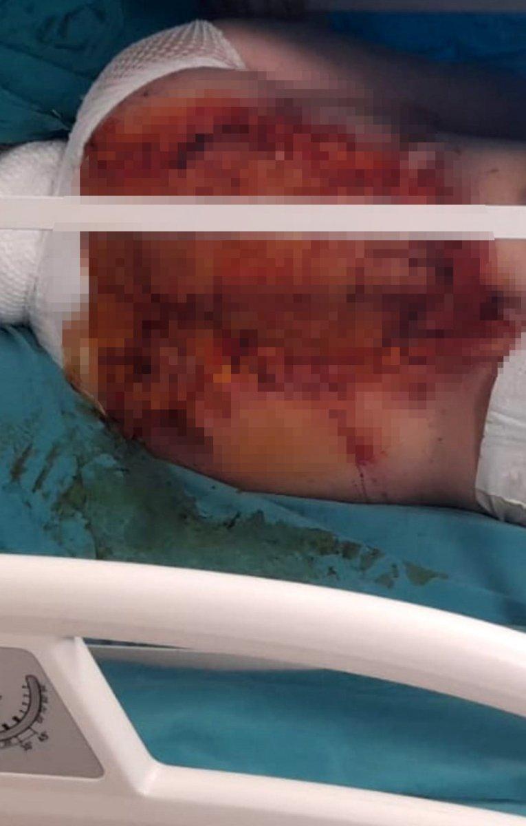 Adana’da, üvey oğlu kezzapla saldırdı