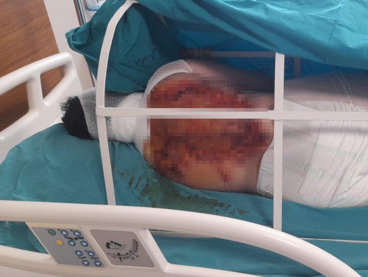 Adana’da, üvey oğlu kezzapla saldırdı