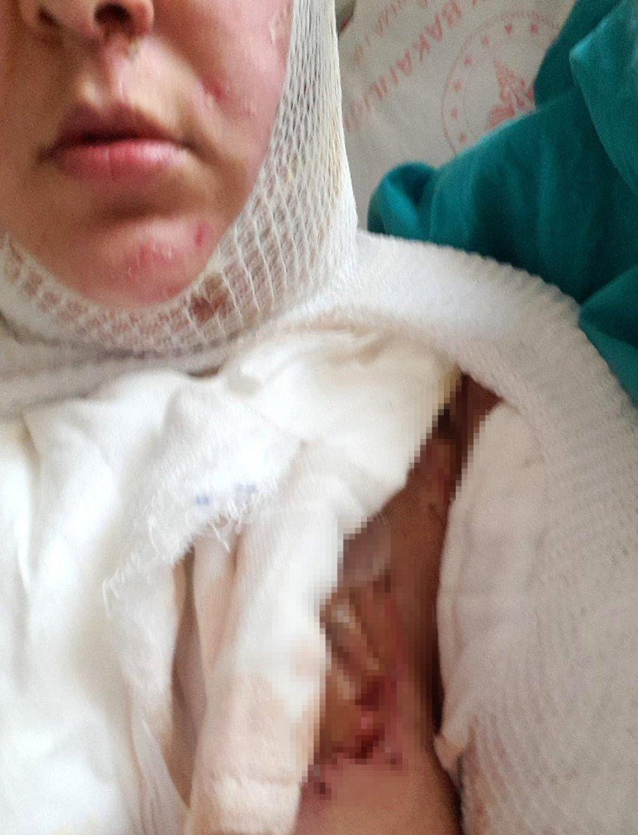 Adana’da, üvey oğlu kezzapla saldırdı