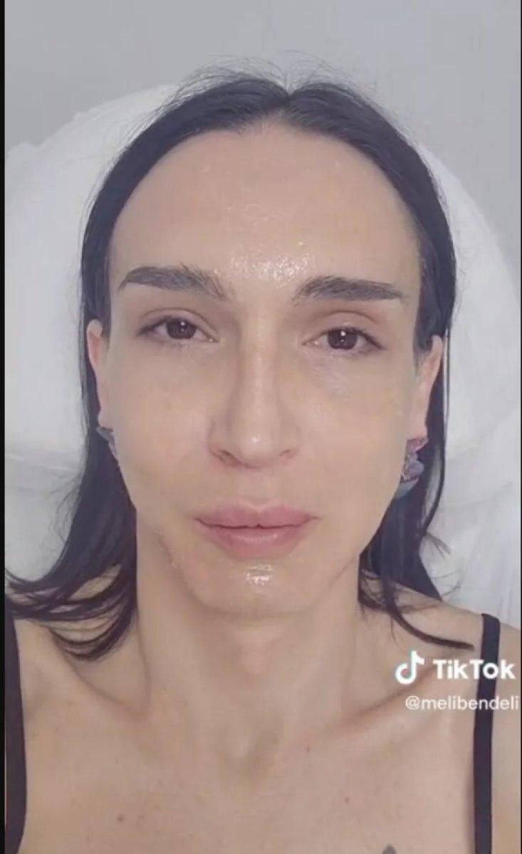 Çukur'un Timsah Celil'i dolgu yaptırdı