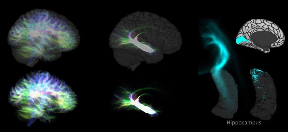 Sinir yollarının en ayrıntılı haritası oluşturuldu