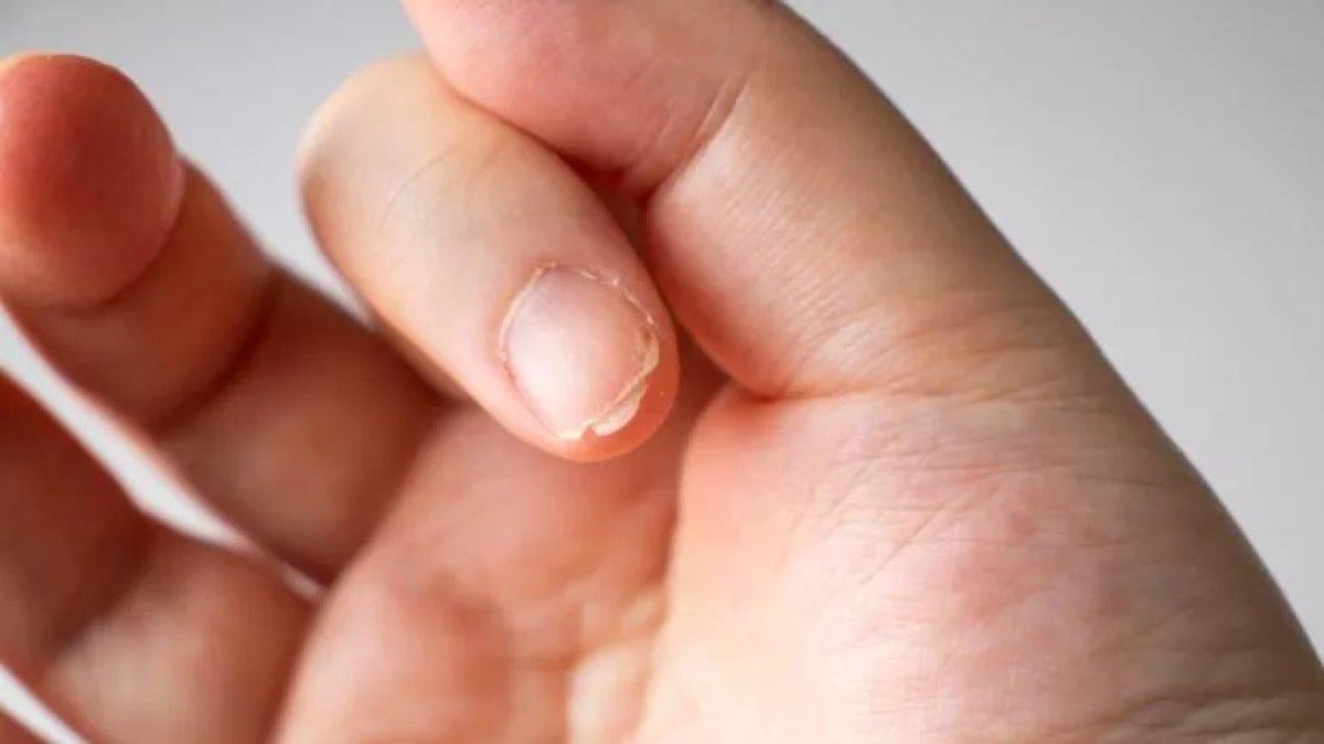 Tırnaklar neden çabuk kırılır? Tırnakları güçlendirmenin yolları