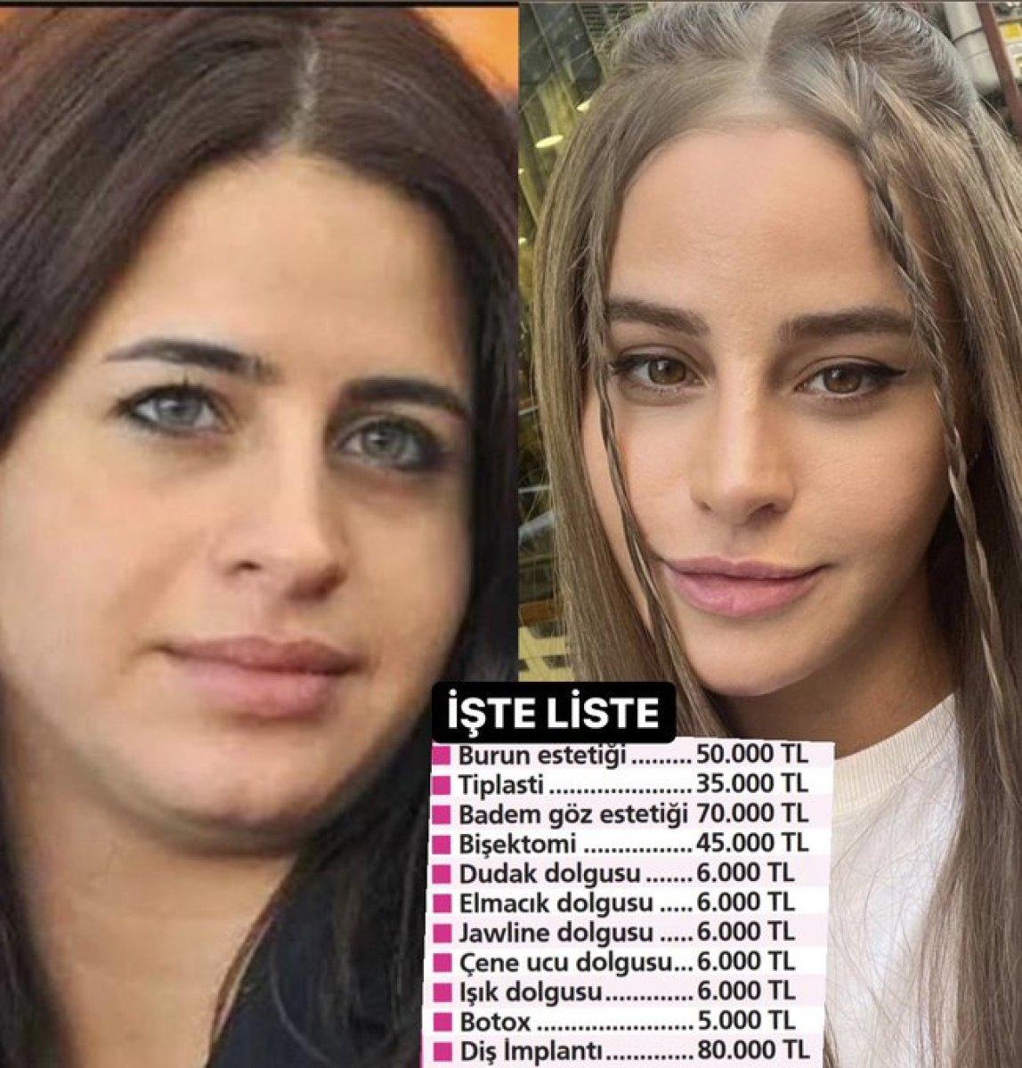 Büşra Pekin'in estetik faturası