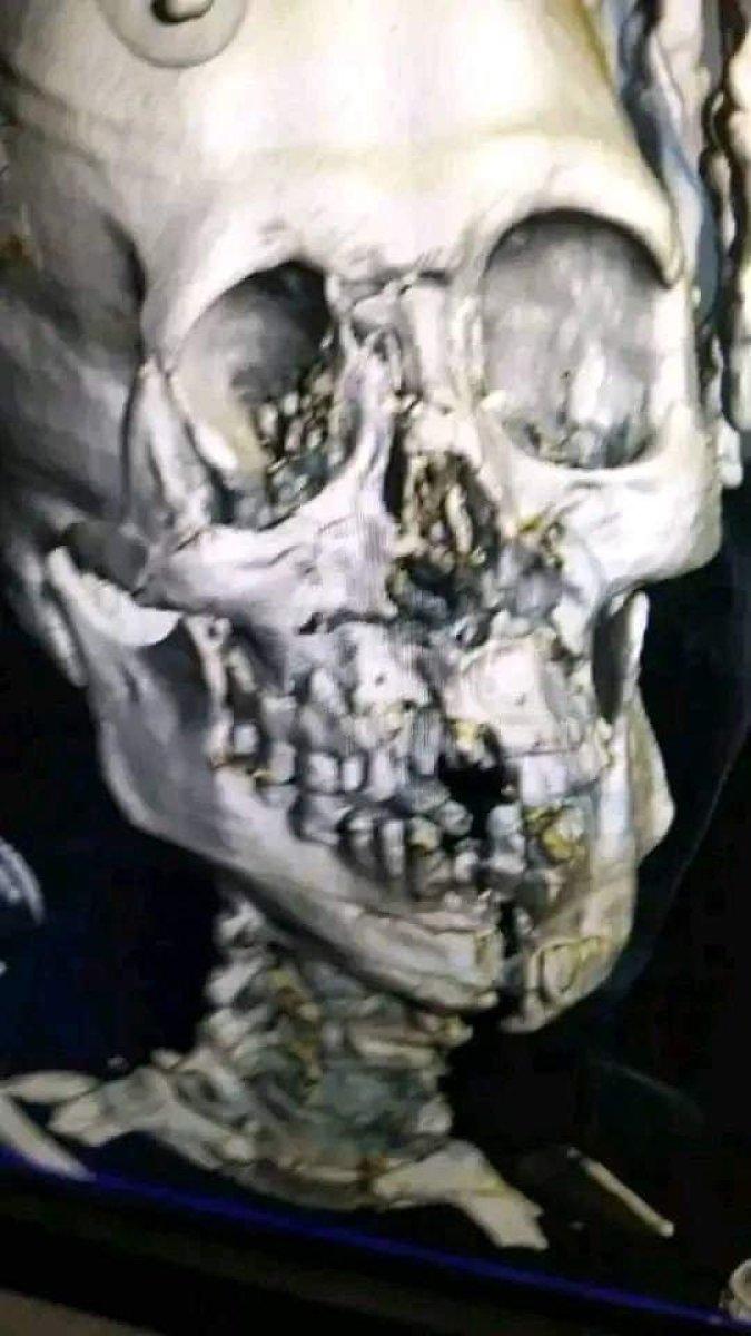 Kaleciyle çarpışan Yasir Al Shahrani'nin son durumu