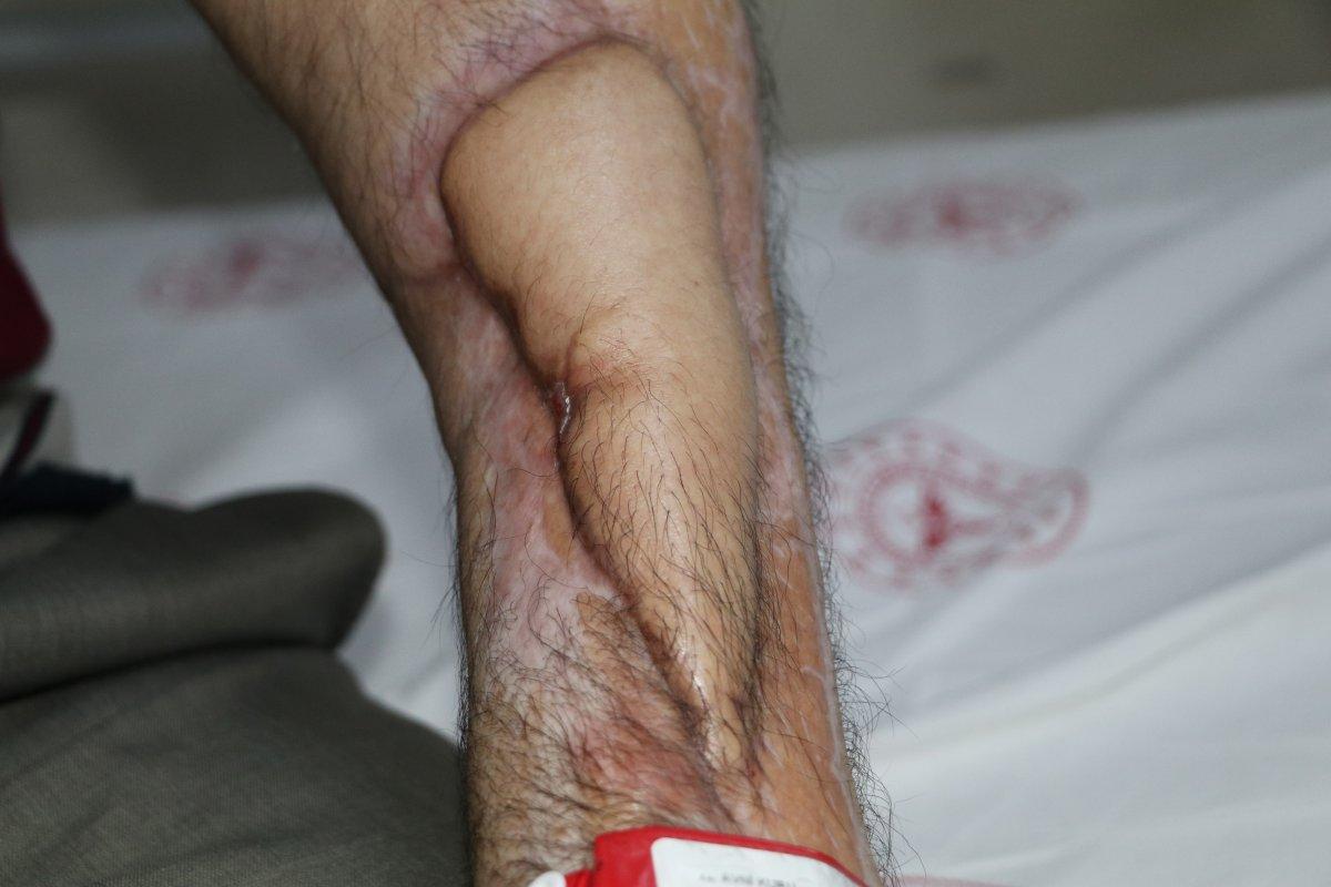 17 kez ameliyat oldu, çürüyen kolu doku nakli ile kurtuldu