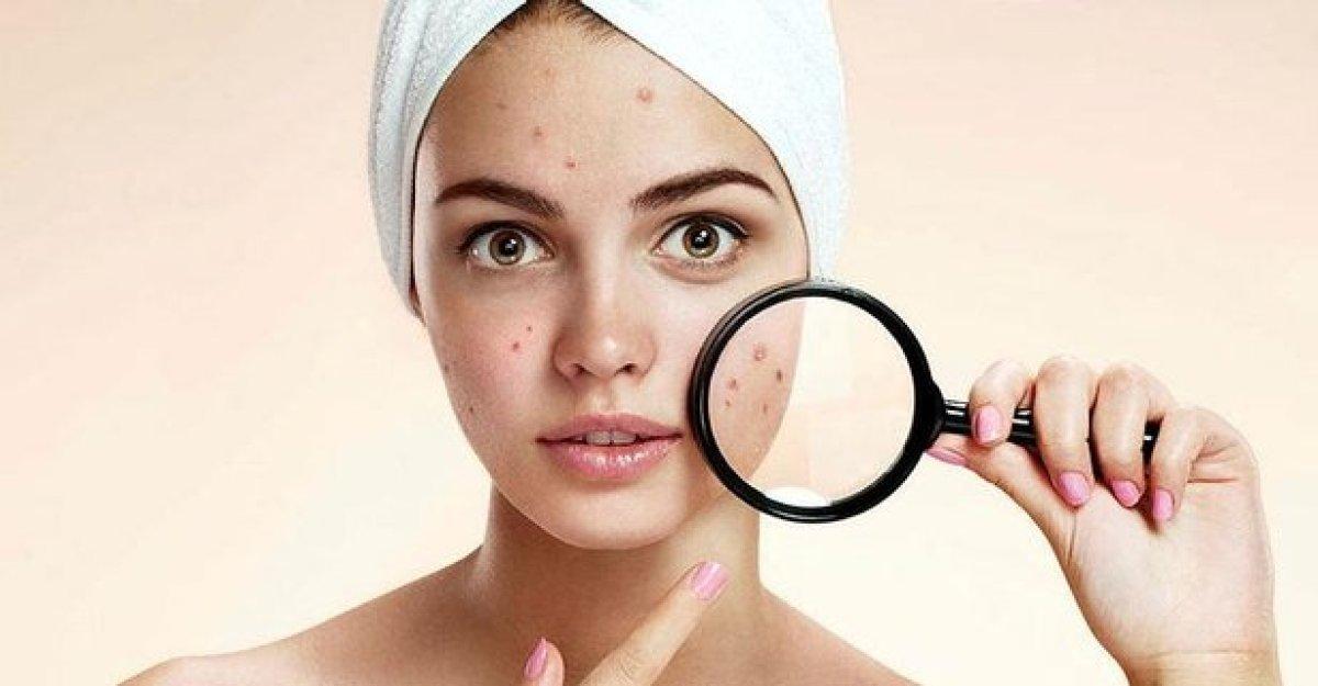 Ergenlik döneminde çıkan akne - sivilce için en iyi tedavi yöntemleri