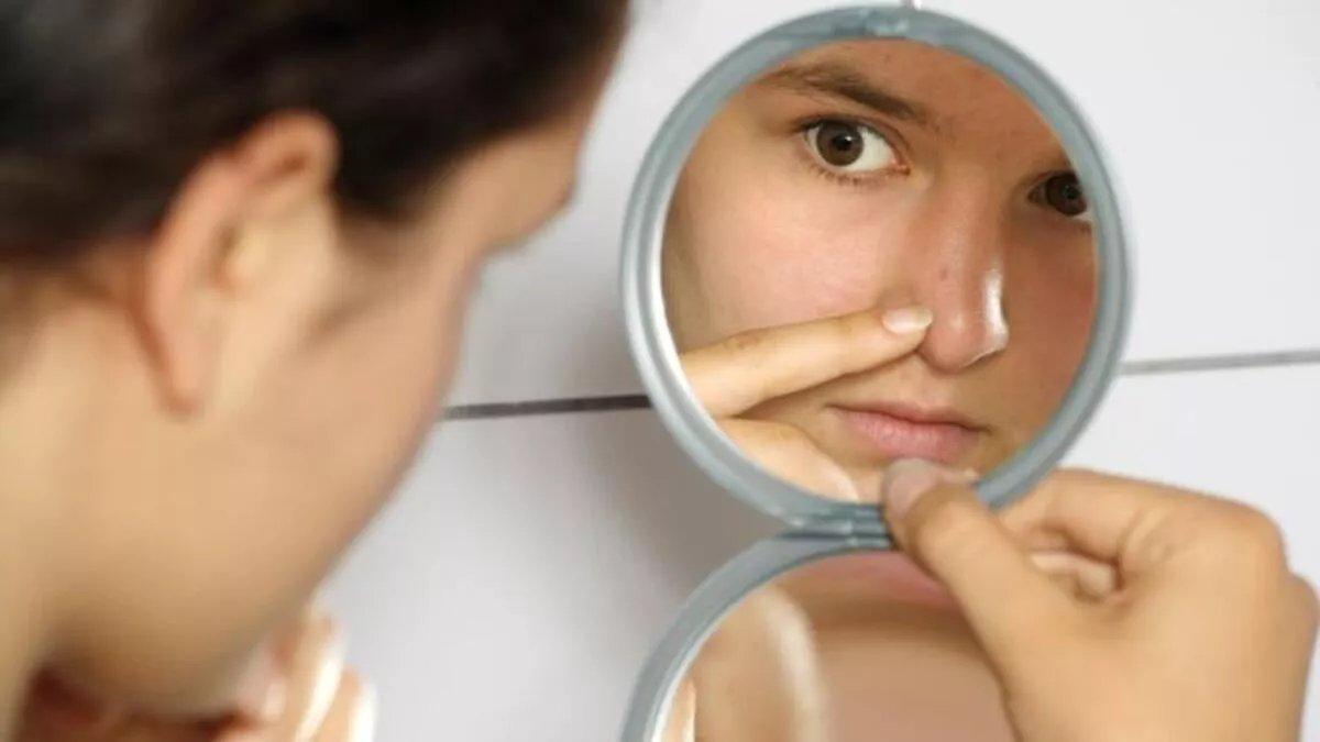 Ergenlik döneminde çıkan akne - sivilce için en iyi tedavi yöntemleri