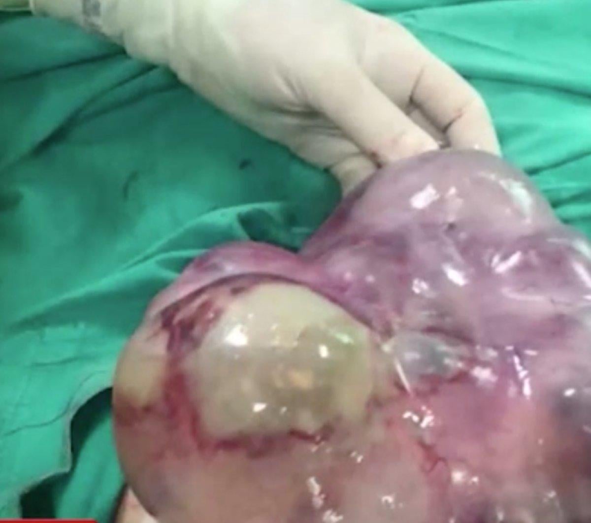 Van'da 15 yaşındaki kızın karnından 7,5 kilogram kitle çıktı 