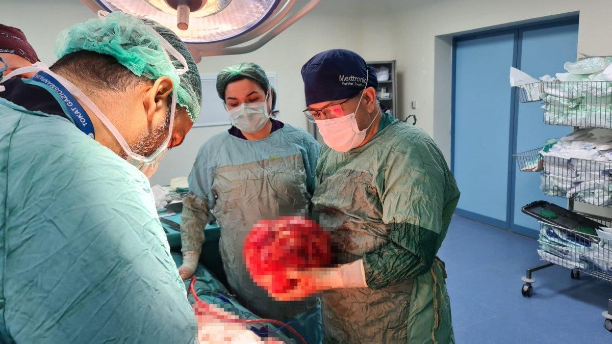 Tokat'ta, hastanın karnından 13 kilogram kitle çıktı