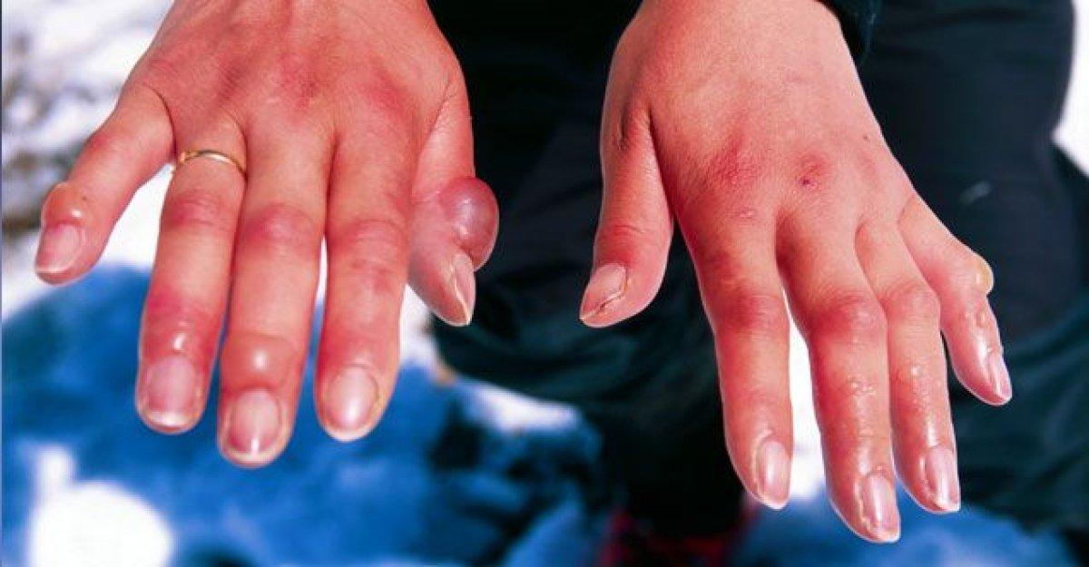 Kışın acı yanı: Soğuk ısırığı nedir, belirtileri nelerdir? Soğuk ısırması tedavisi