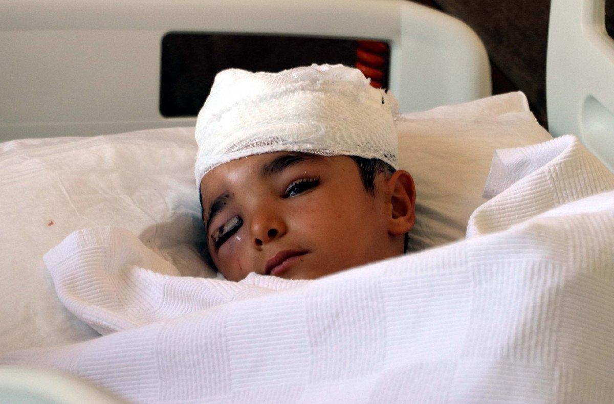 Gaziantep'te sokak köpeği küçük çocuğun kafa derisini koparttı