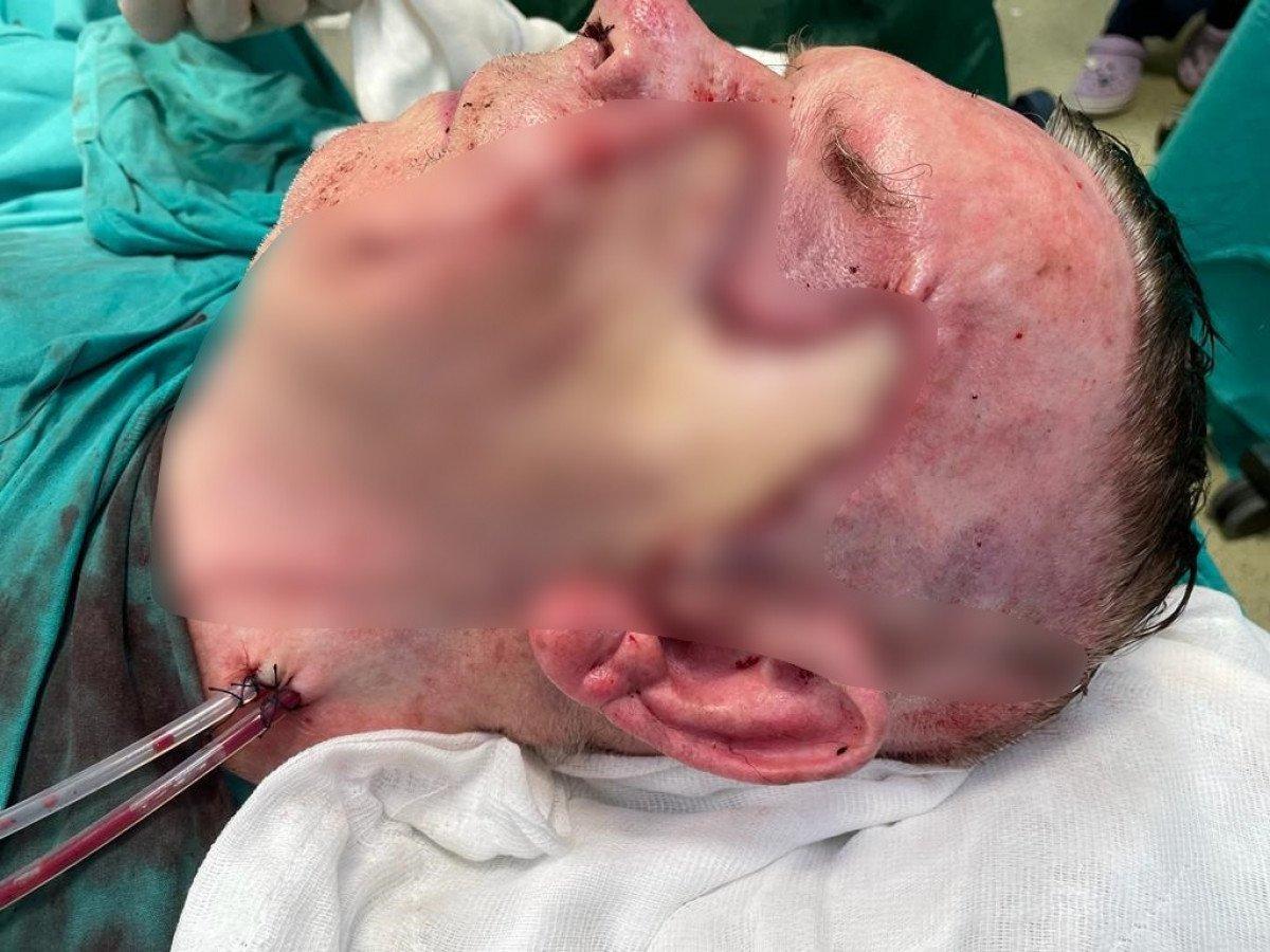 İstanbul'a gelen Rus hastanın yüzünden 2 yumruk büyüklüğünde tümör çıktı