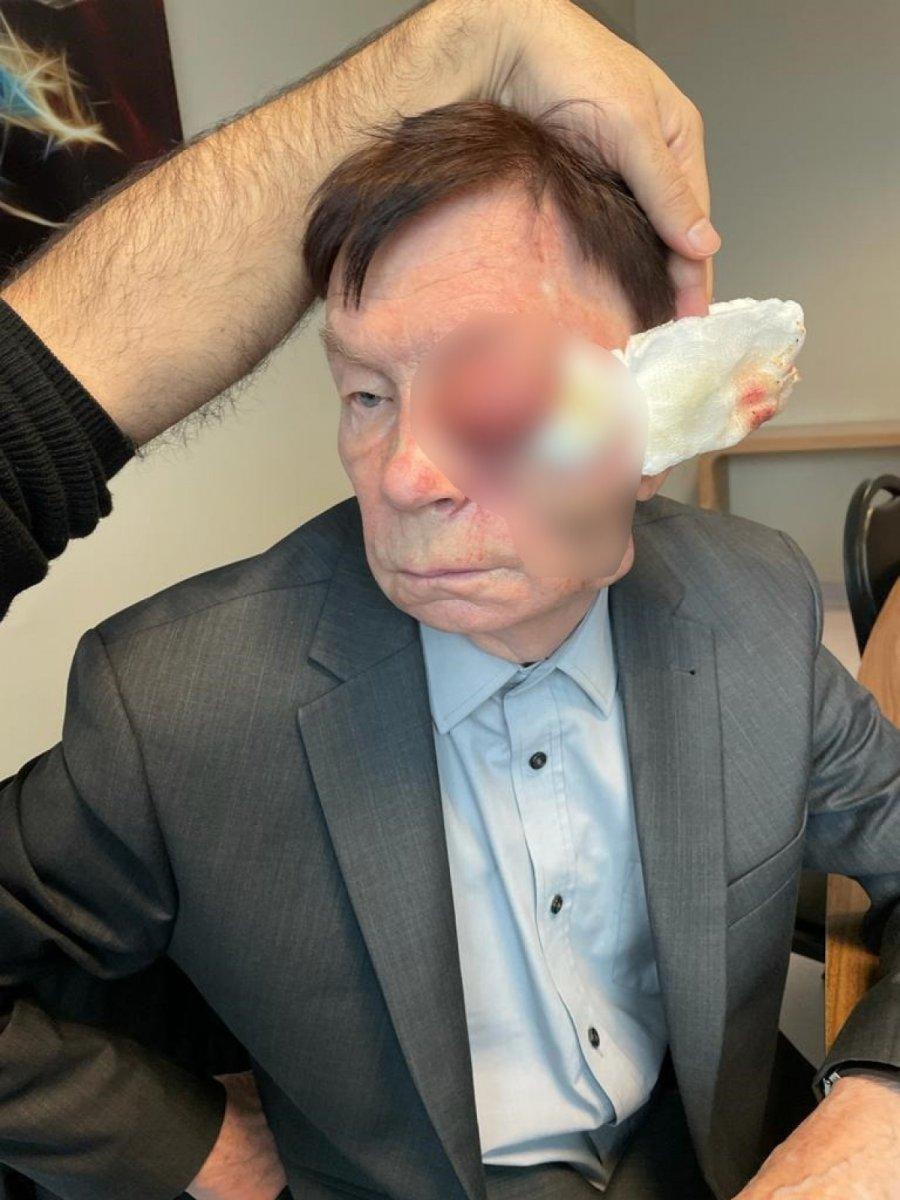 İstanbul'a gelen Rus hastanın yüzünden 2 yumruk büyüklüğünde tümör çıktı